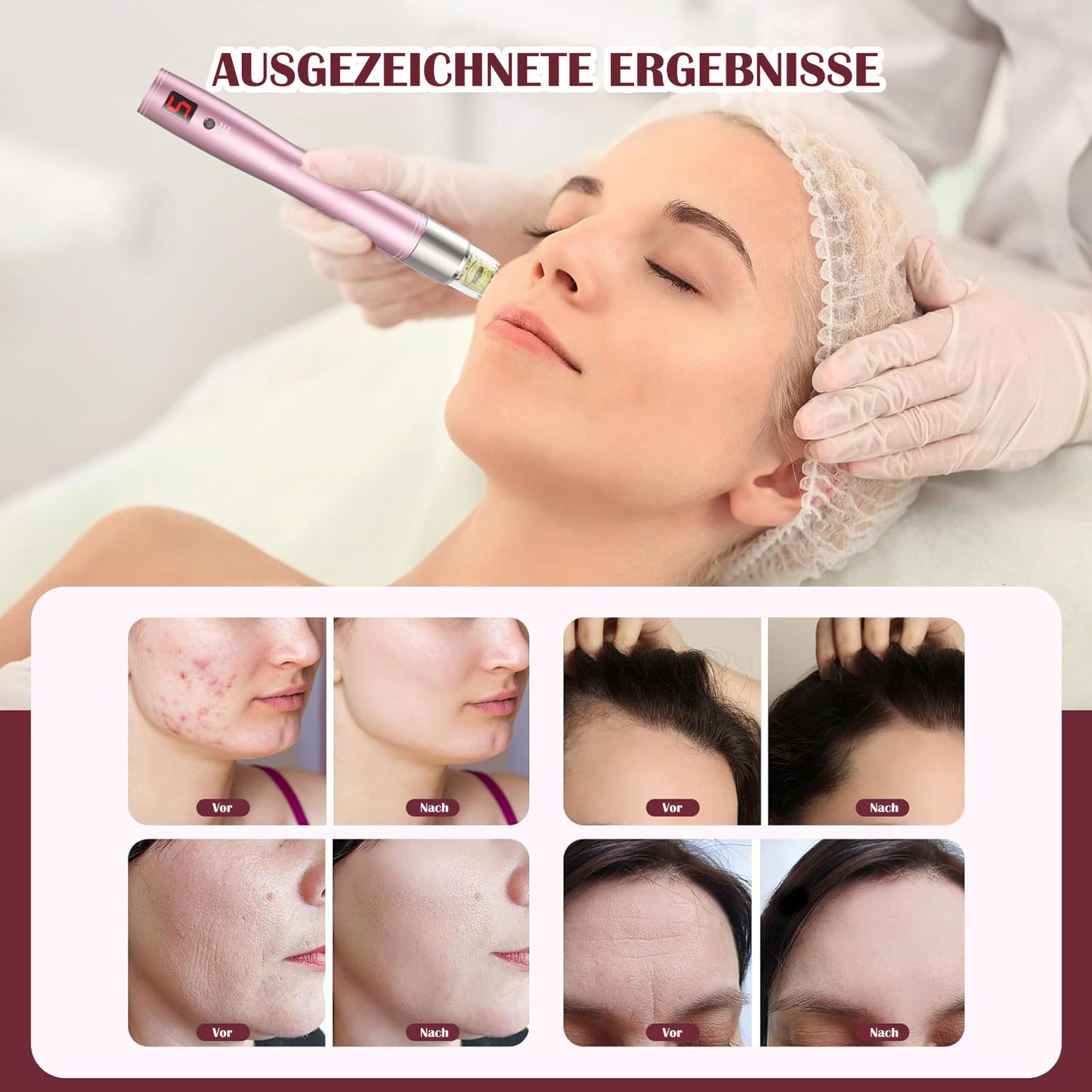 Cool-i ® Elektrischer Microneedling Pen – Kabellos & Wiederaufladbar, mit 5 Intensitätsstufen – Für kosmetische Hautpflege zuhause (A3)