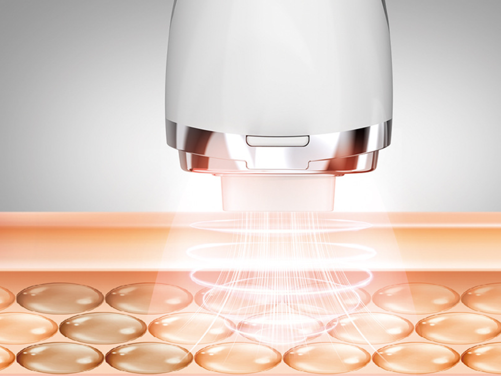 COOL-i® RF Gerät: Tiefenwirksame Radiofrequenz-Technologie - Die Grafik zeigt, wie die RF-Energie in die Hautschichten eindringt und die Kollagenproduktion anregt.