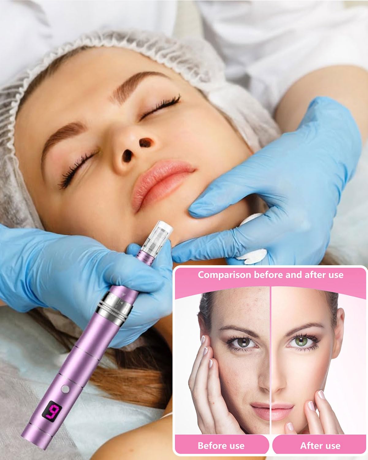 Cool-i® 20 Stk. Microneedling-Nadeln – 12-Pin Ersatzaufsätze, einzeln steril verpackt – kompatibel mit Microneedling Pen zur Hautpflege & Porenverfeinerung.(V2)